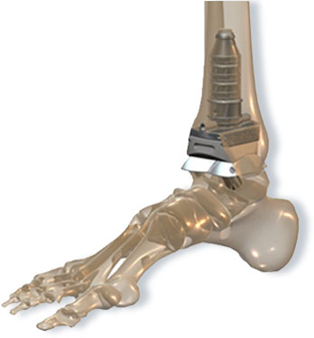 INBONE™ Total Ankle System