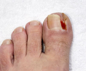 https://www.feetnet.com/images/services/ingrown-toenail.jpg