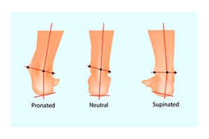 Excessive Supination Affects Your Foot Health