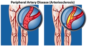 Understanding the Impact of PAD on Foot Health