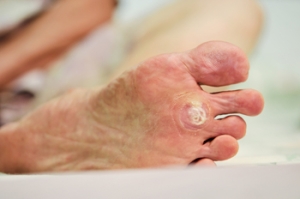 How Plantar Warts Spread