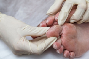 Diabetic Foot Blisters