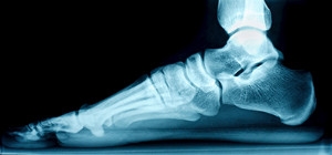 2 Categories of Flat Feet