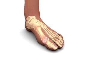 The Impact of Gout and Hyperuricemia
