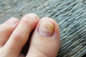 Symptoms and Diagnosis of Toenail Fungus
