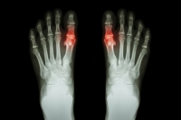 Joint Pain From Gout