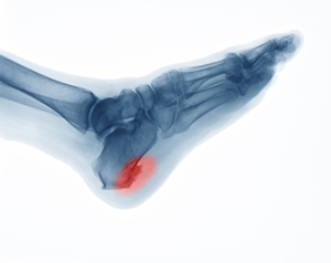 Types and Symptoms of Heel Spurs
