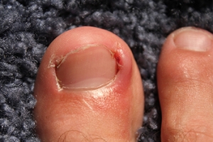 Causes and Prevention of Ingrown Toenails